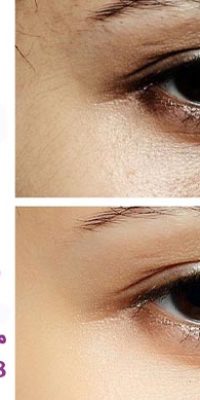 Whitening-under-the-eyes 1